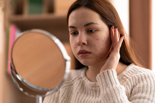 Can Azelaic Acid Help Reduce Acne or Breakouts? - Healing Pharma
