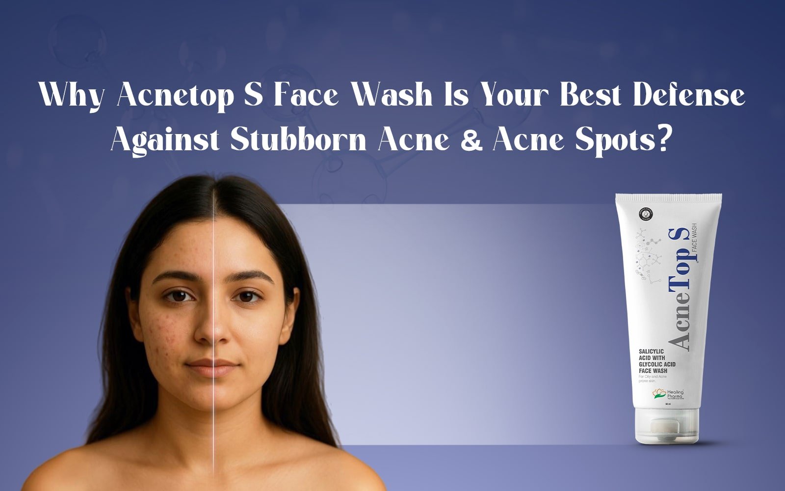 Acnetop Clear Acne Fast with Acnetop S Face Wash – Healing Pharma