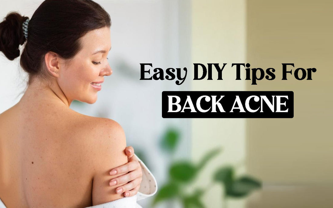 Easy DIY Tips For Back Acne - Healing Pharma
