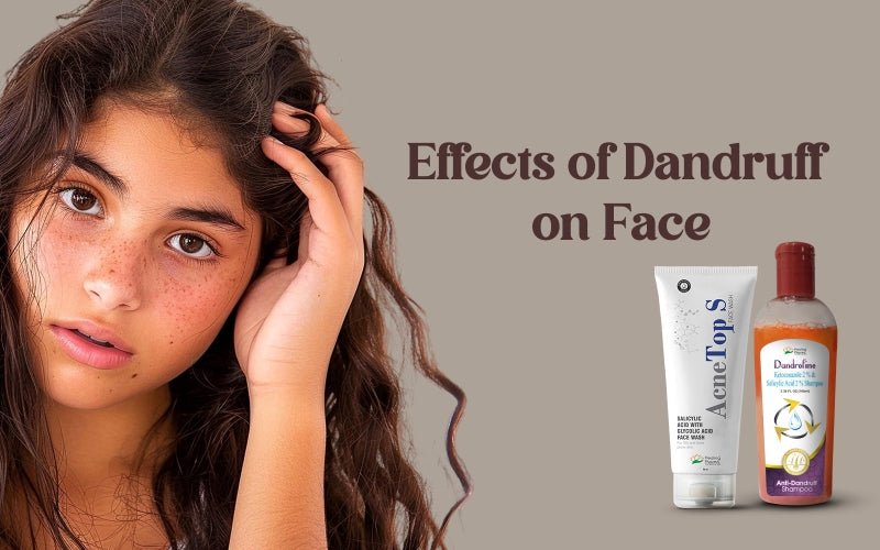 Effects of Dandruff on Face - Healing Pharma