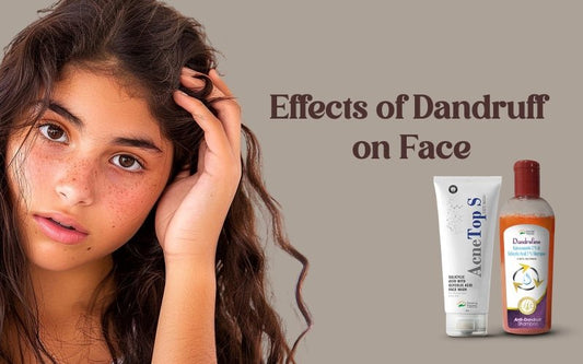 Effects of Dandruff on Face - Healing Pharma