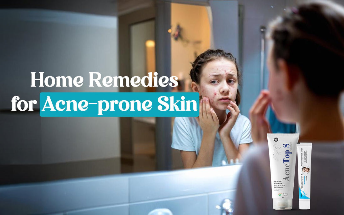 Home Remedies for Acne-prone Skin - Healing Pharma