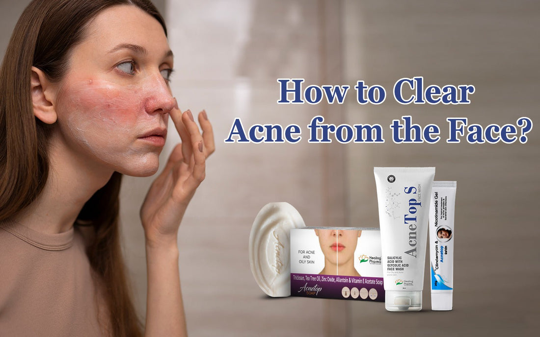 How to Clear Acne from the Face? - Healing Pharma