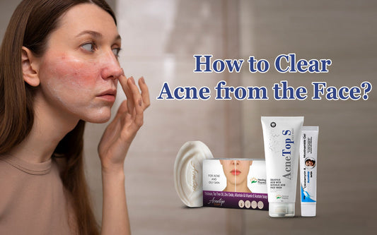 How to Clear Acne from the Face? - Healing Pharma