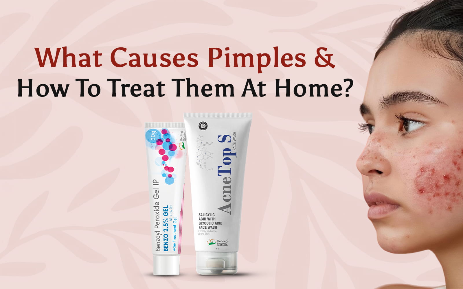 What Causes Pimples & Home Treatment Guide – Healing Pharma
