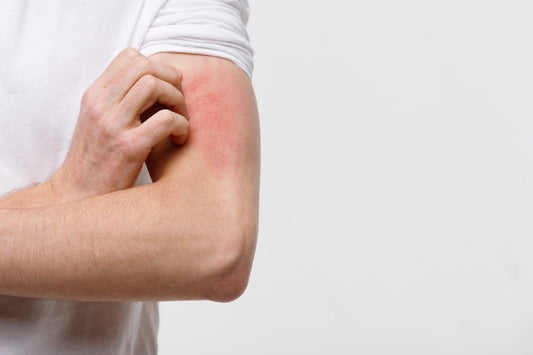World Psoriasis Day: Know 6 Myths and Facts About This Condition - Healing Pharma