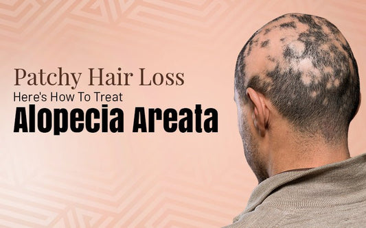 Patchy Hair Loss: Here's How To Treat Alopecia Areata - Healing Pharma