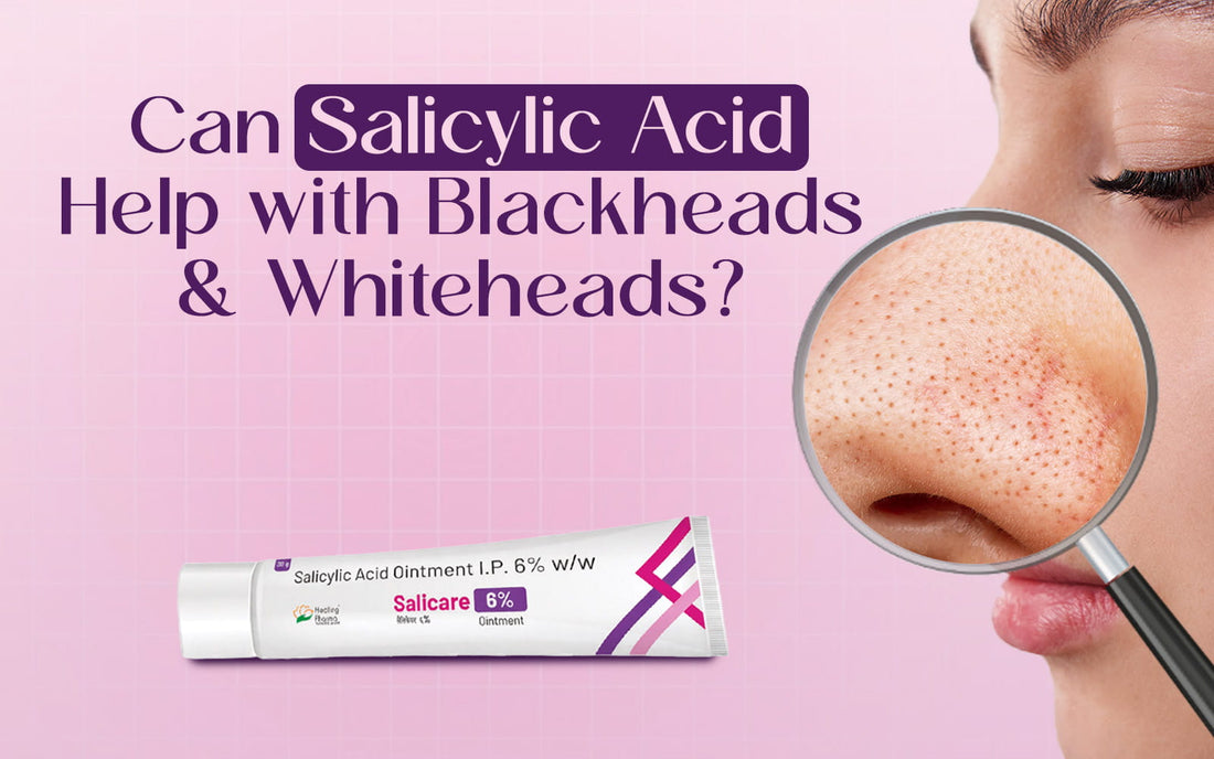salicylic acid for blackheads