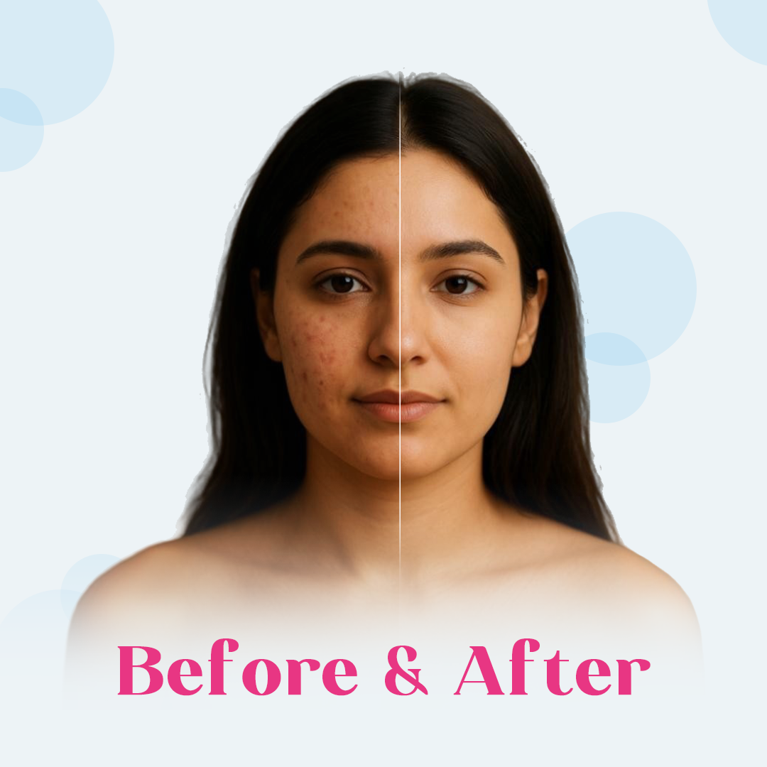 Best Benzoyl Peroxide