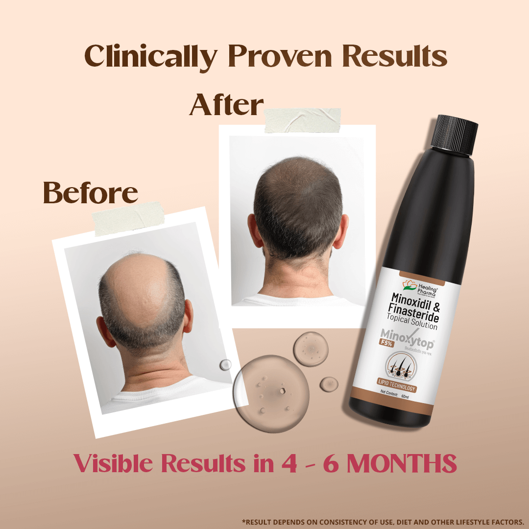 Minoxytop F 5% - Minoxidil Finasteride Hair Regrowth Solution