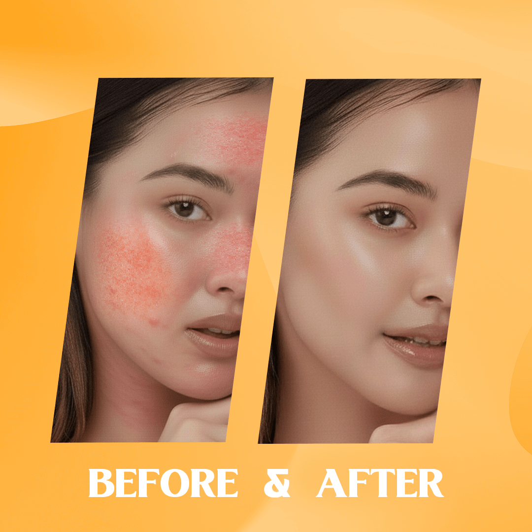 azelaic acid cream uses