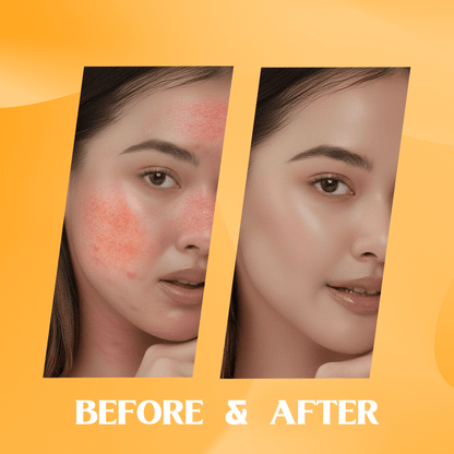 azelaic acid cream uses