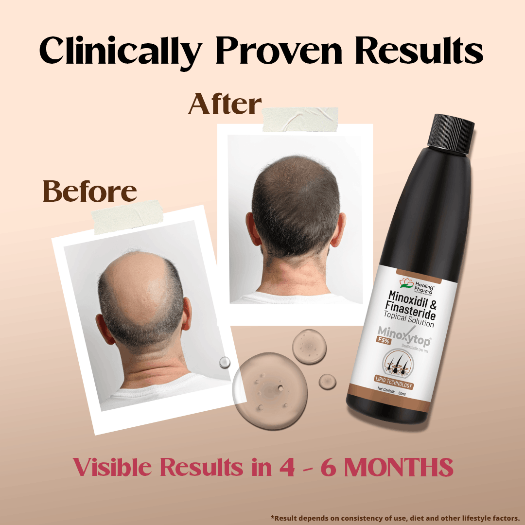 minoxidil finasteride solution price