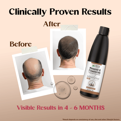 minoxidil finasteride solution price